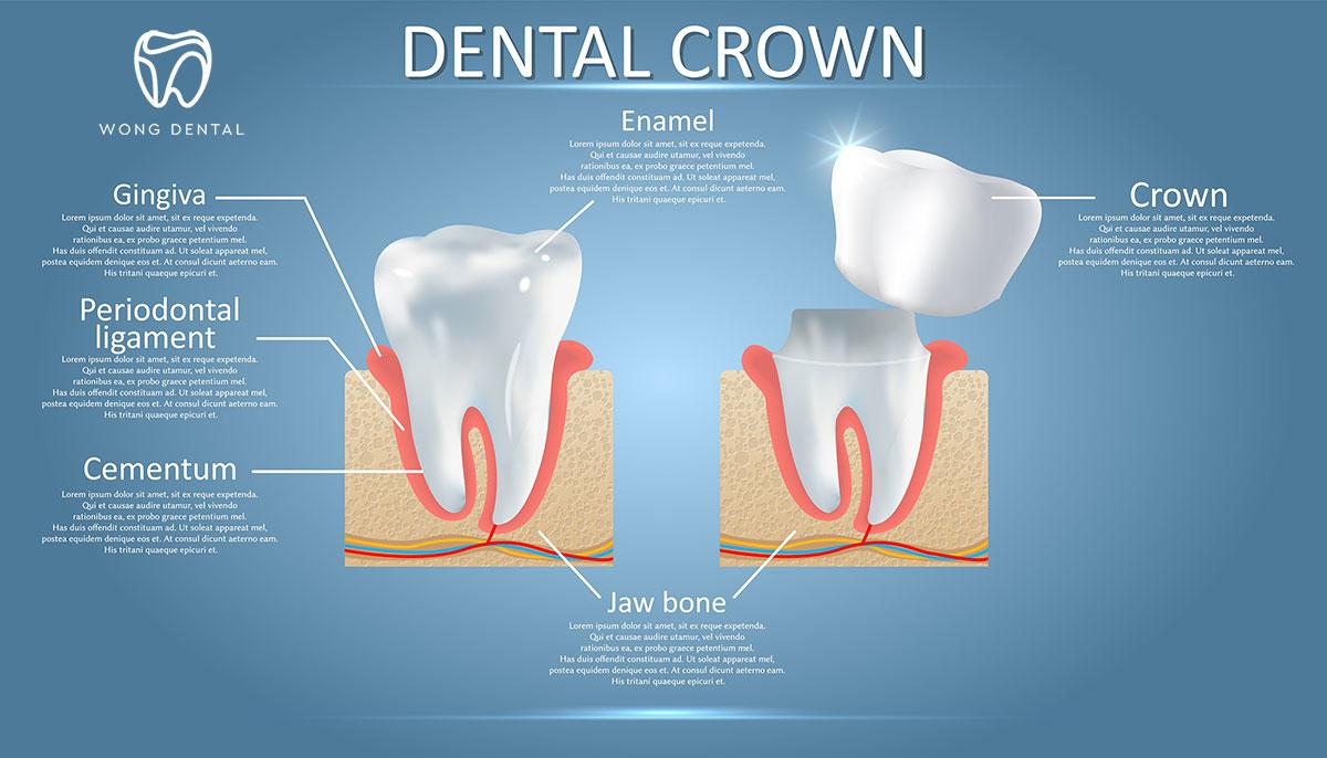 infographic about dental crowns in Castro Valley: Wong Dentistry