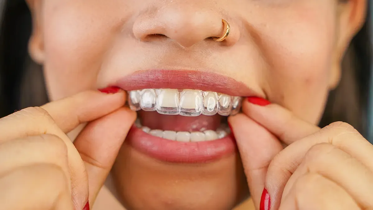 Woman with SureSmile® Clear Aligner at Wong Dentistry in Castro Valley